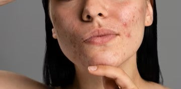 What Is the Cause of Acne during Menopause?