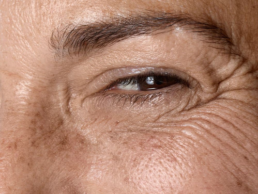 Are Eye Wrinkles Normal